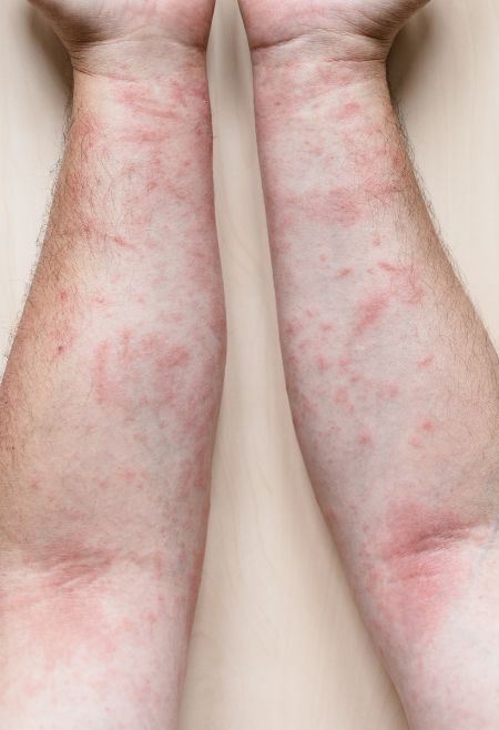 Homeopathic treatment for Fungal Infections of skin and nails